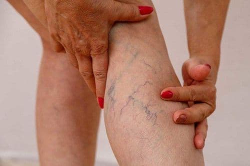 Nhận Biết Sớm Các Dấu Hiệu Suy Giãn Tĩnh Mạch